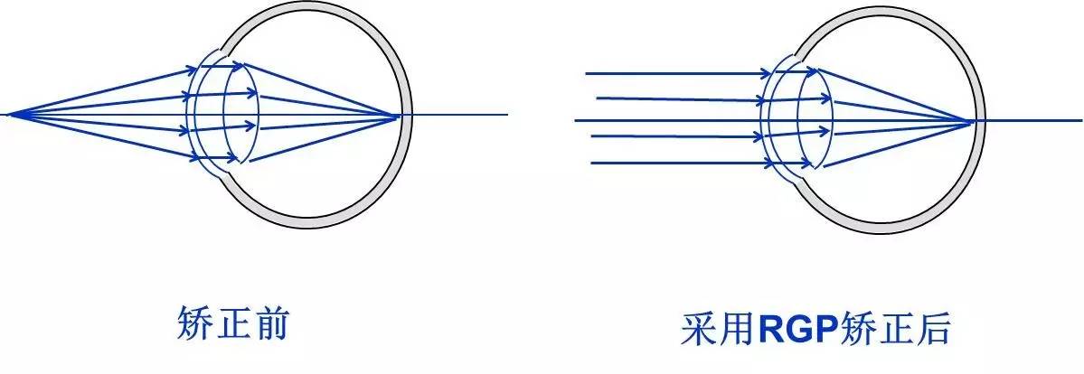 CCOS2016刘陇黔：弱视屈光矫正