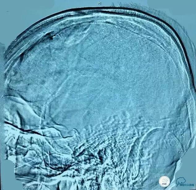 下肢血栓微创介入治疗的费用,急性深静脉血栓形成的诊断和治疗