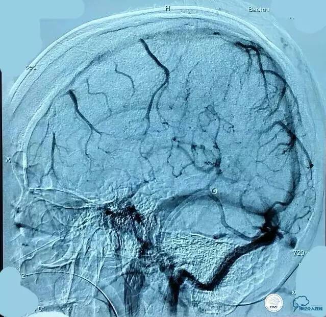 下肢血栓微创介入治疗的费用,急性深静脉血栓形成的诊断和治疗