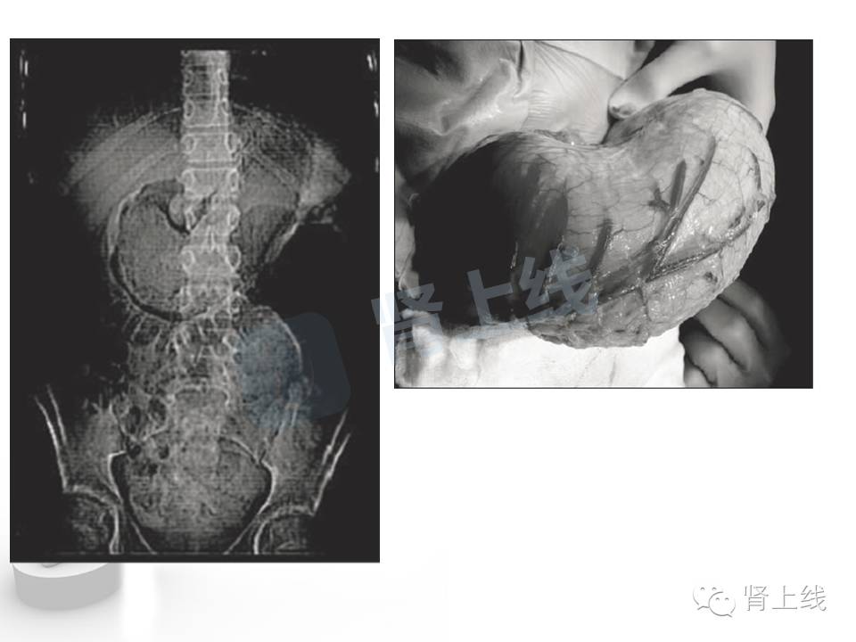 吃山楂取出胃结石,吃10个山楂胃结石有多少