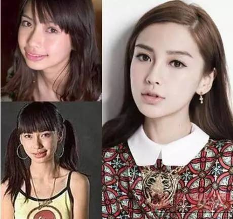 牙齿矫正跟颧骨有什么关系,牙齿矫正和凸嘴的区别