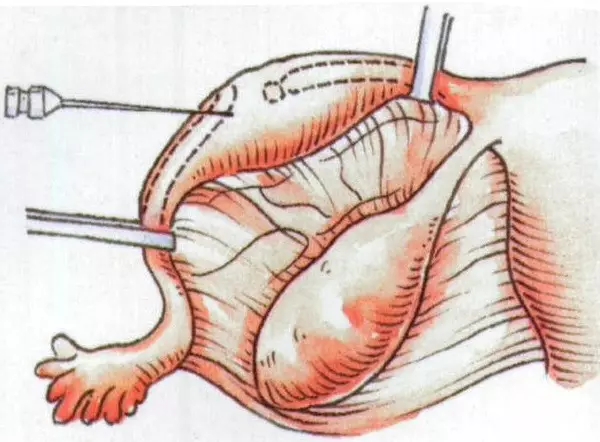 女性二胎后做结扎有影响吗,二胎结扎后想生三胎