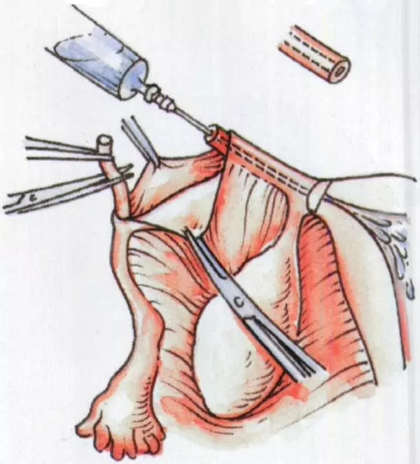 女性二胎后做结扎有影响吗,二胎结扎后想生三胎