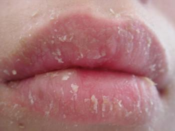 嘴唇裂口脱皮吃什么药,常年嘴唇开裂脱皮是怎么回事