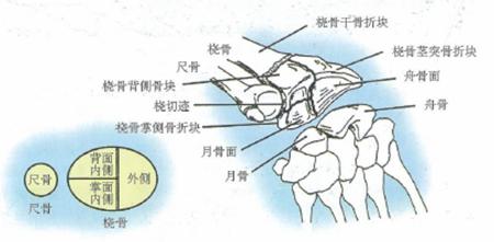 桡骨远端骨折传统石膏打法,成人桡骨远端骨折诊疗指南2023版
