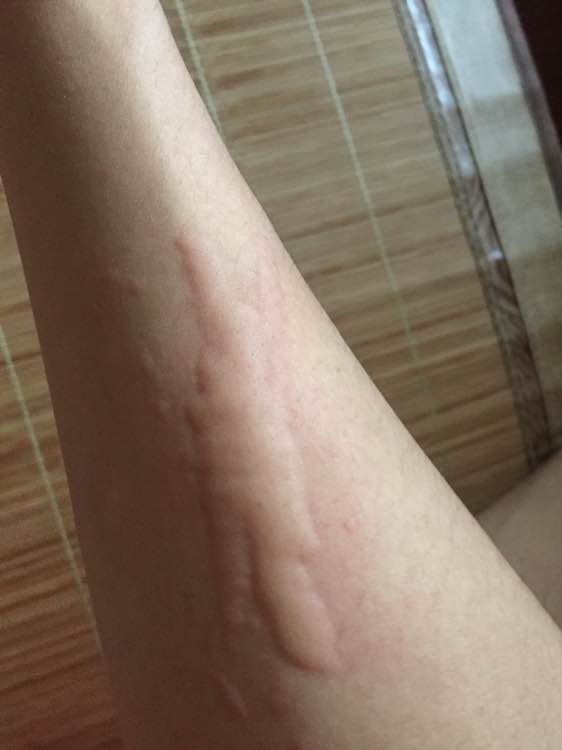 麻疹和荨麻疹的区别是什么,荨麻疹与湿疹的症状有什么区别