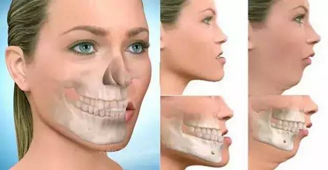 牙齿矫正跟颧骨有什么关系,牙齿矫正和凸嘴的区别