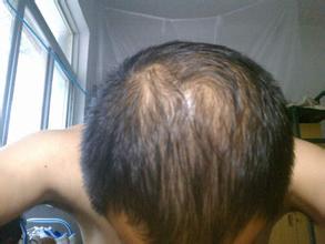 头发上出油用中药怎么治,头发爱出油脱发吃什么中成药调理