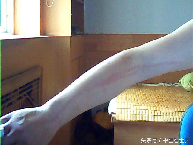 胳膊上突然出了一条长线怎么回事,手臂突然出现一条红线是怎么回事
