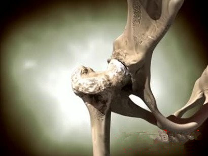 二期股骨头坏死怎样算保髋成功,股骨头坏死有哪些保髋治疗方法