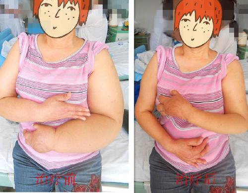 90后演员徐婷去世原因,演员徐婷淋巴癌症状