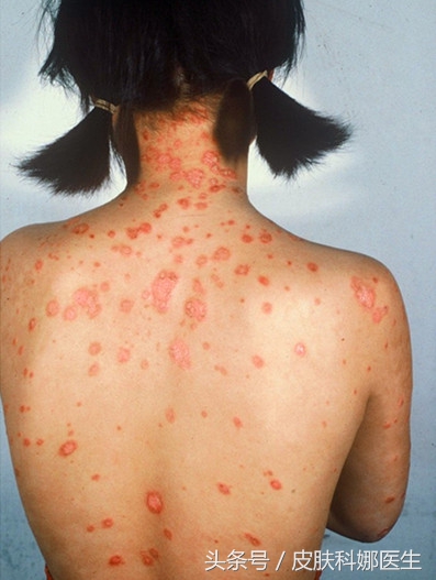 孩子发烧过后脸上起小丘疹,女童发烧身上起红疹是什么原因