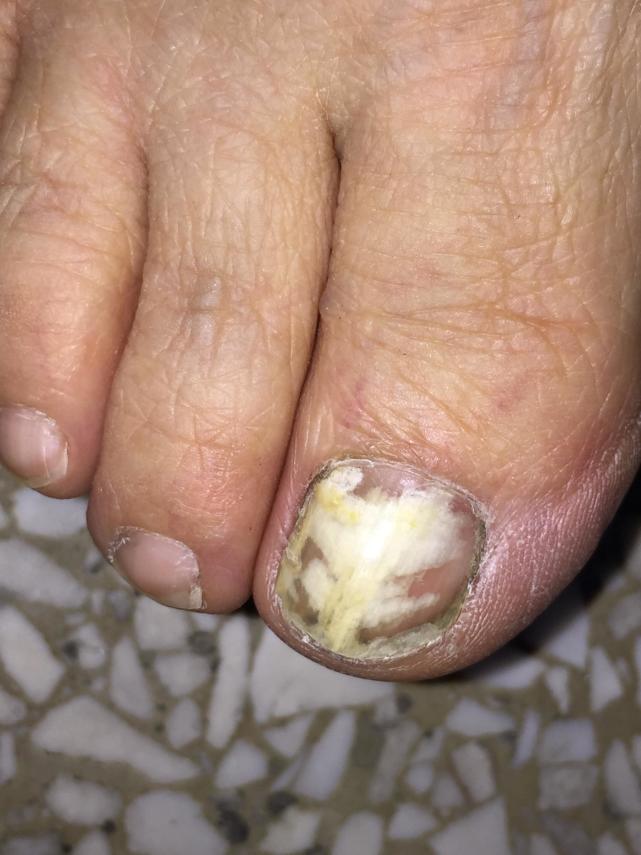 灰指甲为什么反反复复那么难治,为什么这么多人有灰指甲