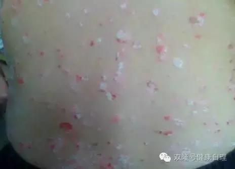 中医说吃醪糟的好处,中医说伤阴最严重症状