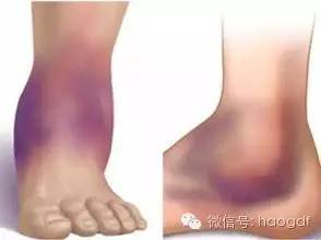 踝关节扭伤的紧急处理方法，转给爱运动的朋友们~~