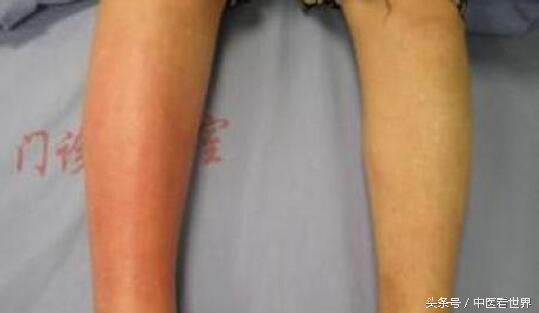 胳膊上突然出了一条长线怎么回事,手臂突然出现一条红线是怎么回事