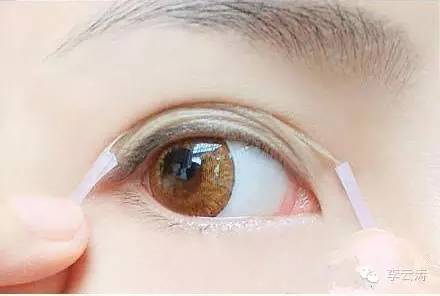 双眼皮18天消肿方法,贴双眼皮教程三眼皮