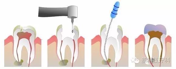 牙科手术关注事项,牙科打麻醉关注事项