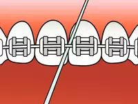 戴上牙套怎么刷牙视频,牙套矫正刷牙的重要性