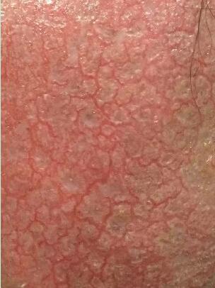 激素皮炎脸怎么修复,小儿皮炎用激素软膏