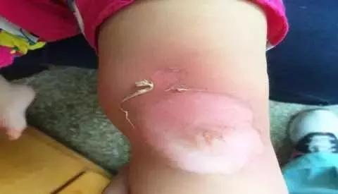 小孩已经烫伤留疤怎样处理,小孩被烫伤留疤了怎么办