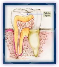 蛀牙怎样才能控制住不再有蛀牙,蛀牙不严重用什么药