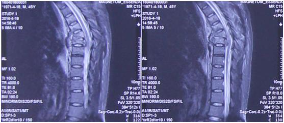 病例压迫神经康复视频,脊髓损伤康复分享