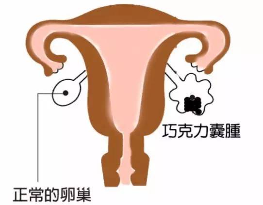 巧克力囊肿能吃药治好么,巧克力囊肿最新治疗方法