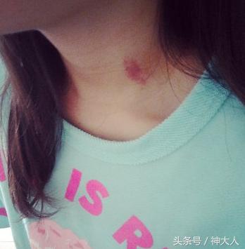 怎么样快速有效去除吻痕,怎么快速有效的去除吻痕