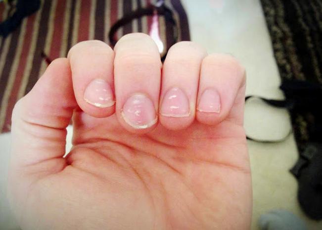 指甲上发现白点,指甲上有白点为什么要看皮肤科