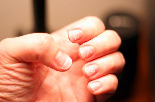 指甲上发现白点,指甲上有白点为什么要看皮肤科