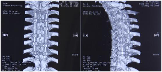 病例压迫神经康复视频,脊髓损伤康复分享