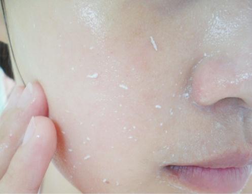 痘痘肌冬天皮肤保湿最好的方法,痘痘敏感肌冬季补水用什么