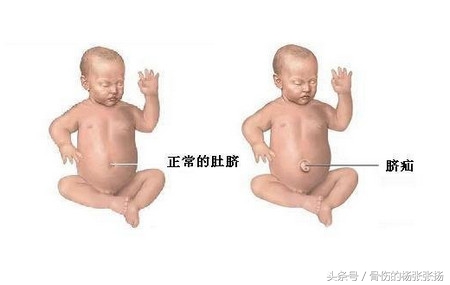 如何预防疝气手术后复发,怎样避免疝气手术后复发