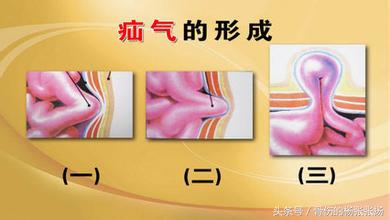 如何预防疝气手术后复发,怎样避免疝气手术后复发