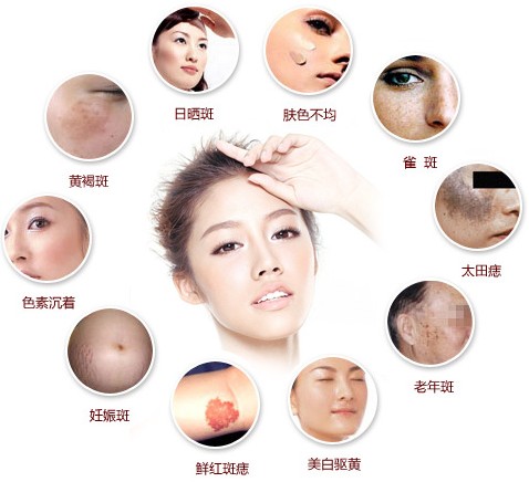 激光祛斑和皮秒祛斑哪个效果好,彩光祛斑和激光祛斑的区别是什么