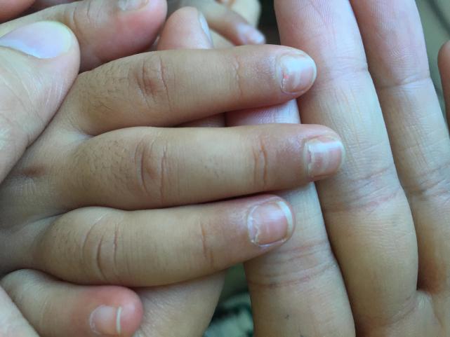 两岁指甲脱落怎么看是不是灰指甲,儿童手指指甲边缘和肉分离怎么办