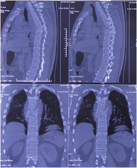 病例压迫神经康复视频,脊髓损伤康复分享