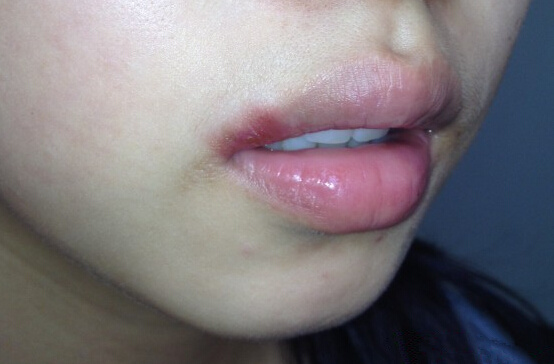 解决烂嘴角的小妙招,烂嘴角好得最快的方法