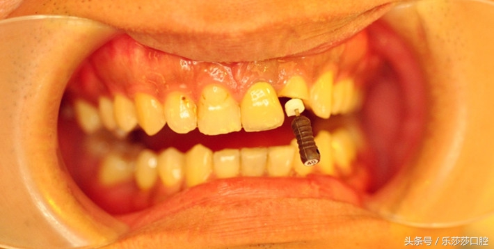 一根针扎进眼珠里会怎么样,一根针放进什么地方容易融化