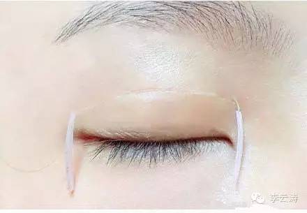 双眼皮18天消肿方法,贴双眼皮教程三眼皮