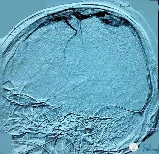 下肢血栓微创介入治疗的费用,急性深静脉血栓形成的诊断和治疗