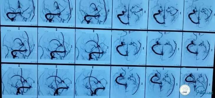 下肢血栓微创介入治疗的费用,急性深静脉血栓形成的诊断和治疗
