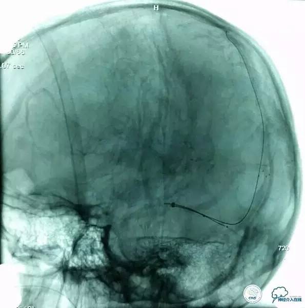 下肢血栓微创介入治疗的费用,急性深静脉血栓形成的诊断和治疗