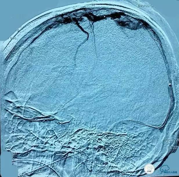 下肢血栓微创介入治疗的费用,急性深静脉血栓形成的诊断和治疗