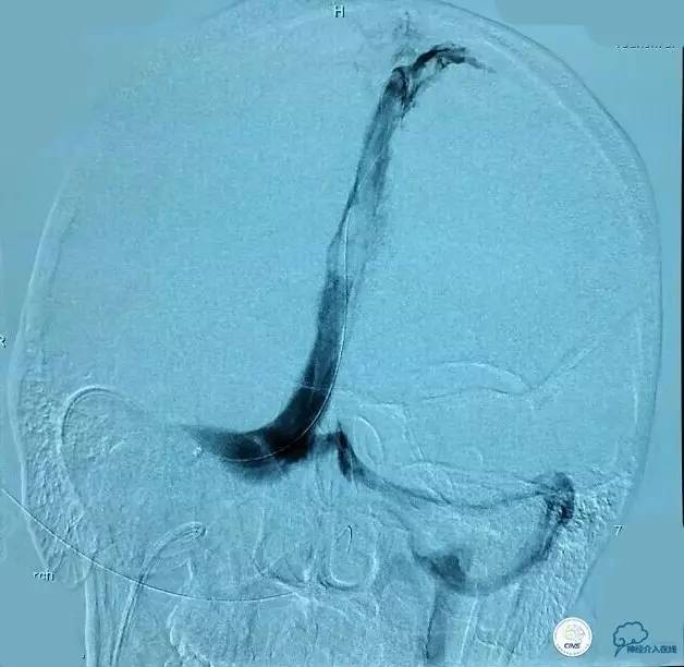 下肢血栓微创介入治疗的费用,急性深静脉血栓形成的诊断和治疗