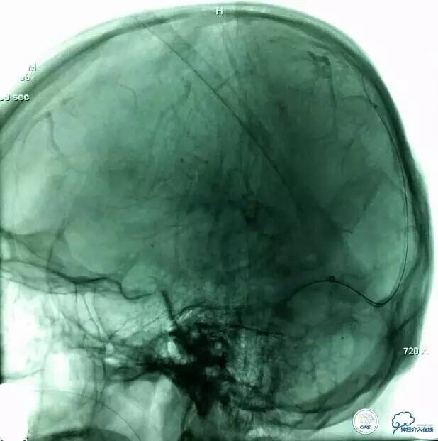 下肢血栓微创介入治疗的费用,急性深静脉血栓形成的诊断和治疗