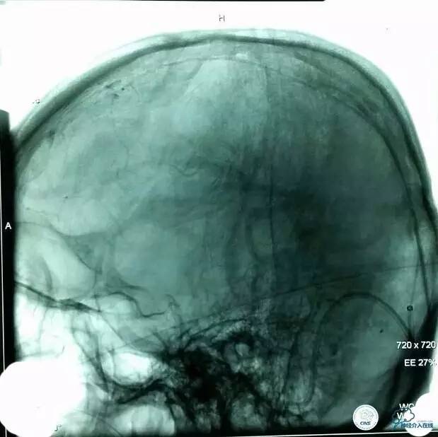 下肢血栓微创介入治疗的费用,急性深静脉血栓形成的诊断和治疗