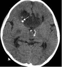 周忠清颅咽管瘤全切的终身复发率,周忠清谈颅咽管瘤术后寿命