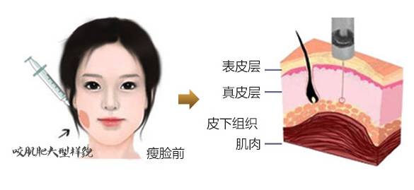 整容脸肿网红,整容包子脸网红